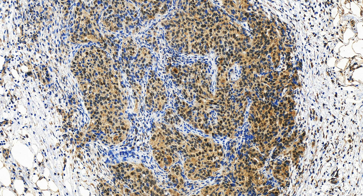 IHC staining of human ovary cancer using 18333-1-AP