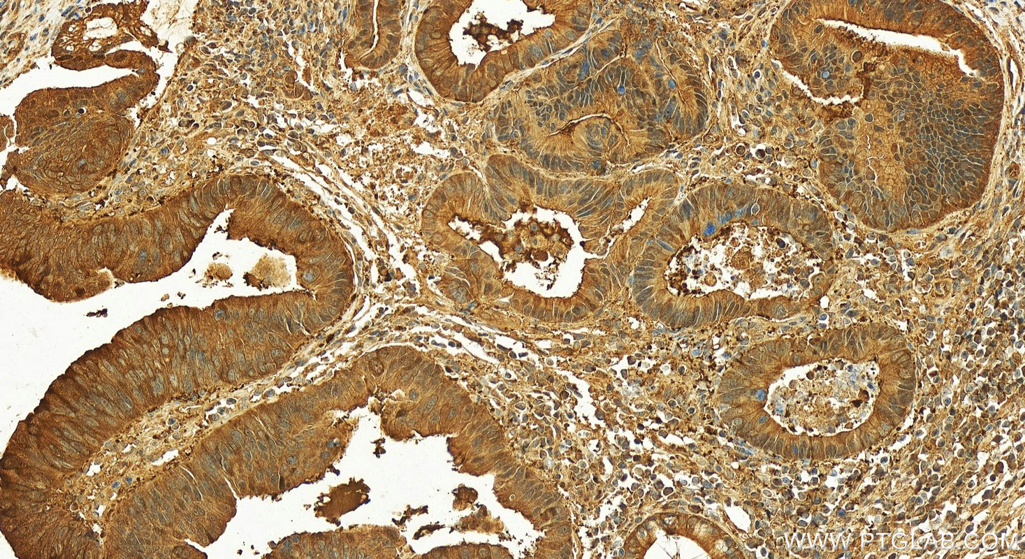 IHC staining of human colon cancer using 26863-1-AP