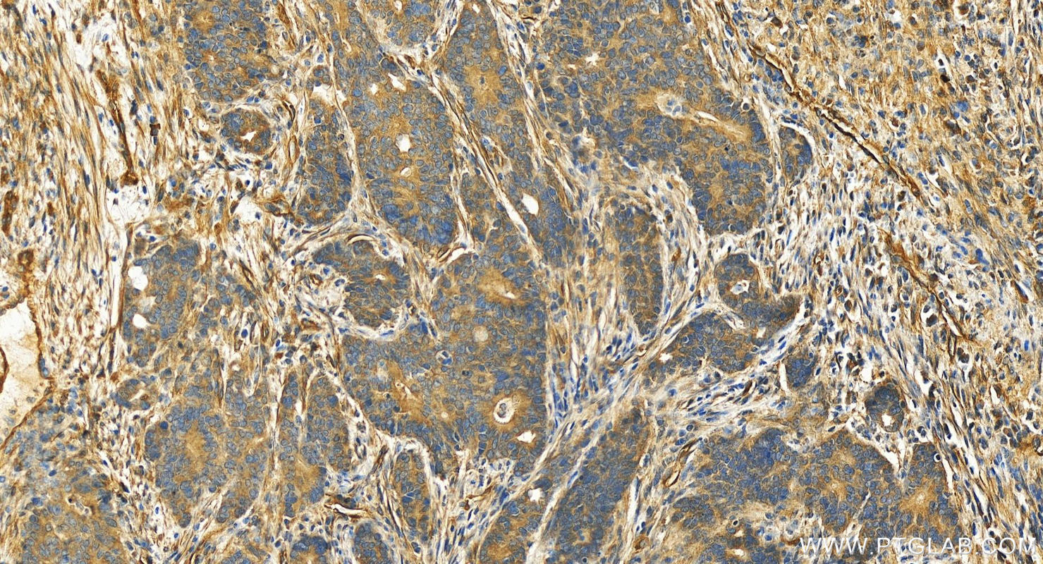 IHC staining of human stomach cancer using 17507-1-AP