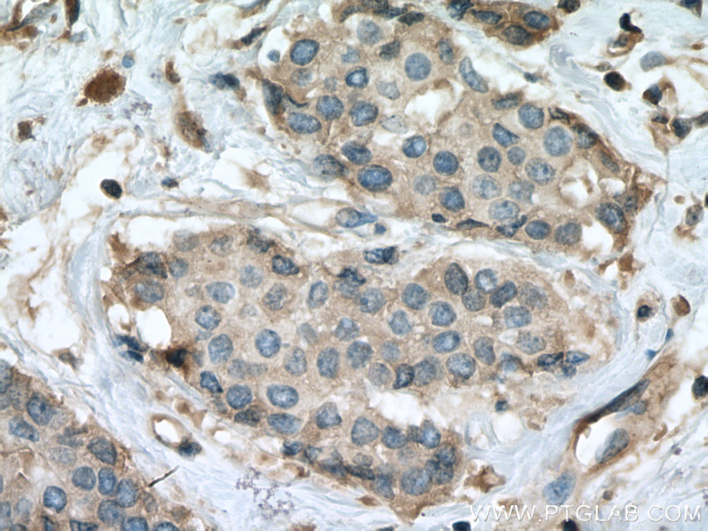 IHC staining of human breast cancer using 67093-1-Ig (same clone as 67093-1-PBS)