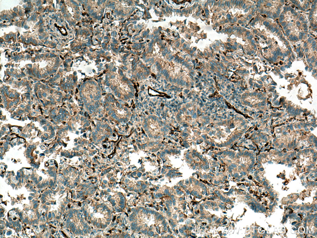IHC staining of human lung cancer using 67094-1-Ig (same clone as 67094-1-PBS)