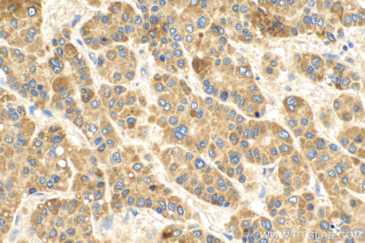 IHC staining of human liver cancer using 28330-1-AP