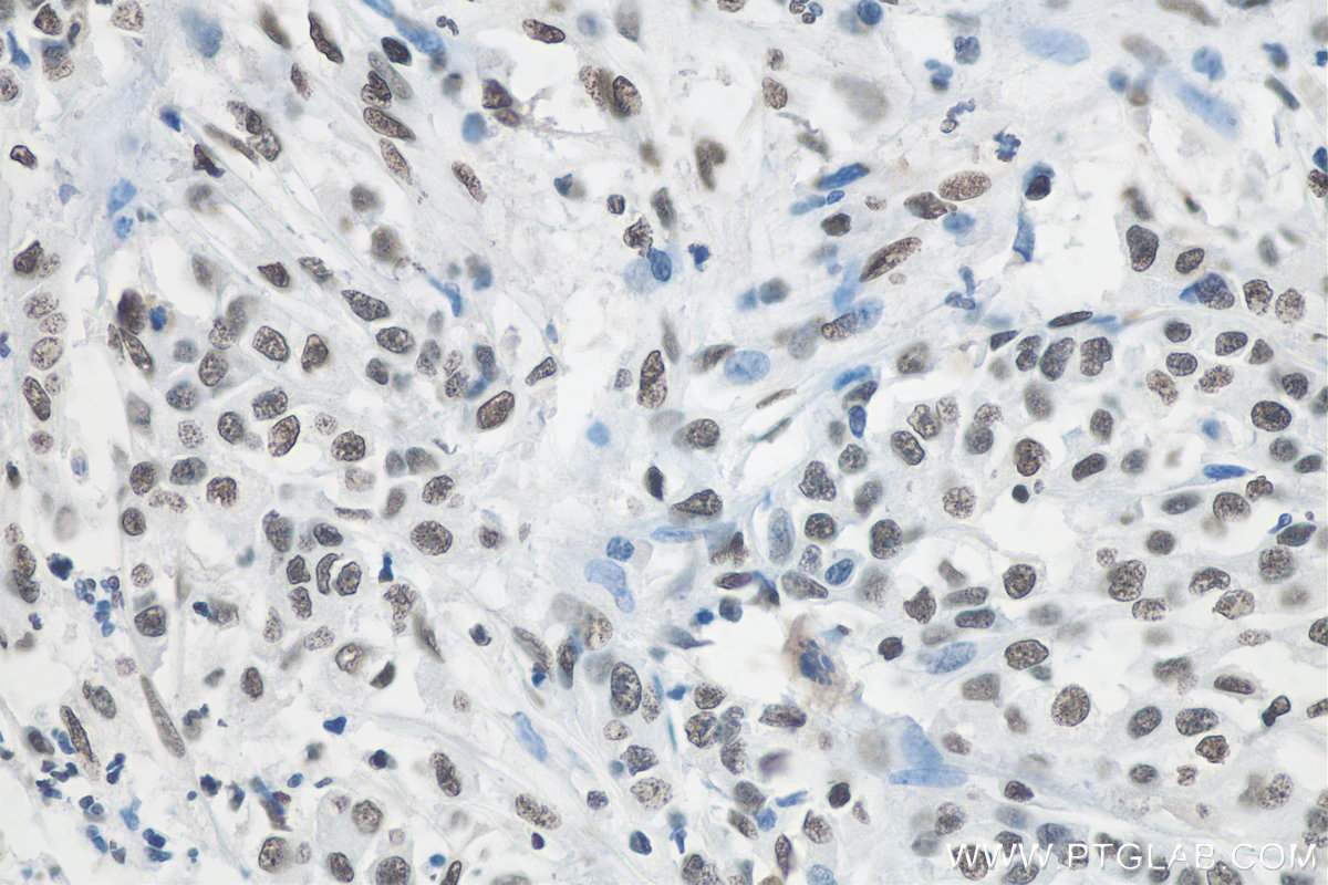 IHC staining of human stomach cancer using 68011-1-Ig