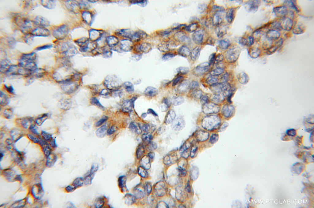 IHC staining of human breast cancer using 11861-1-AP (same clone as 11861-1-PBS)