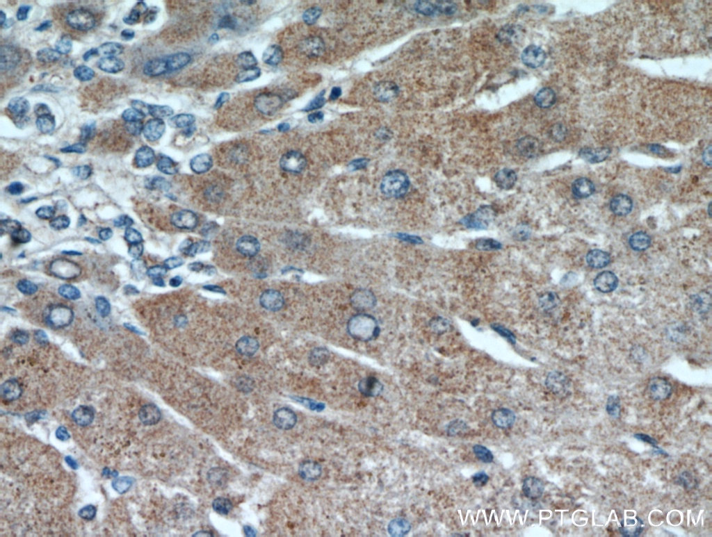 IHC staining of human hepatocirrhosis using 21107-1-AP