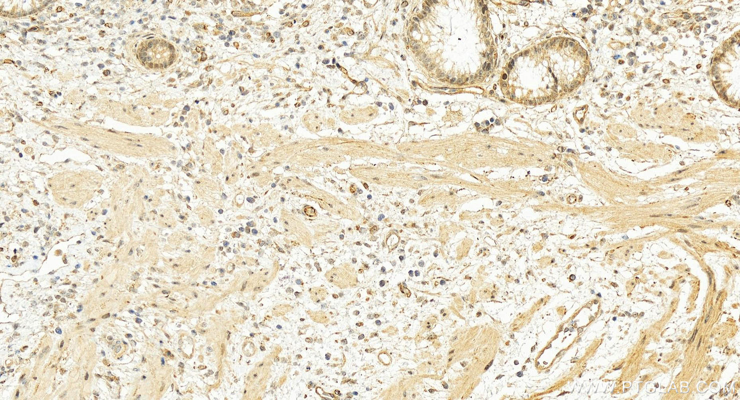 IHC staining of human colon cancer using 10552-1-AP