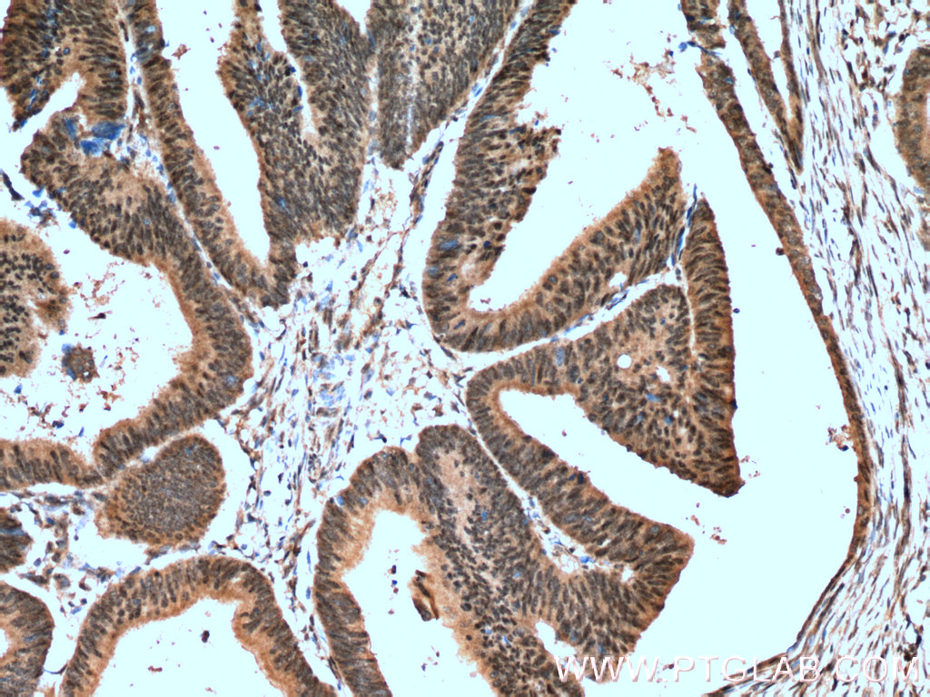 IHC staining of human colon cancer using 10552-1-AP