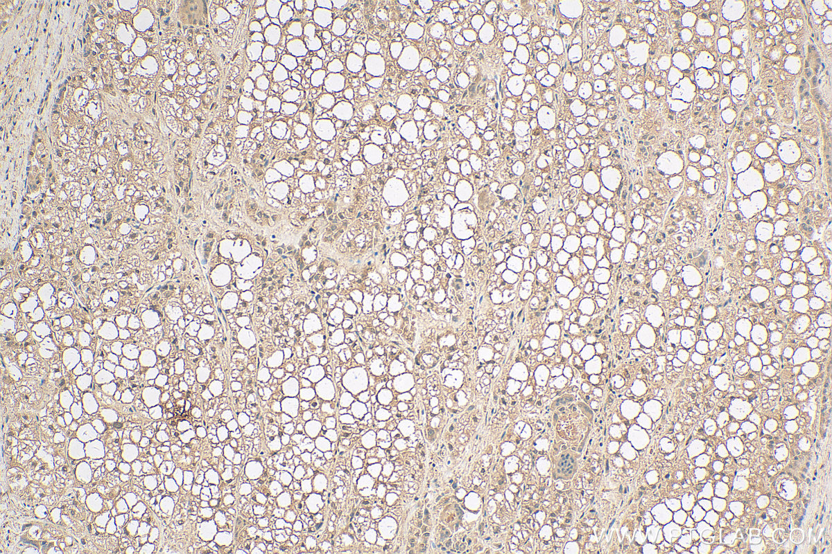 IHC staining of human liver cancer using 68125-1-Ig (same clone as 68125-1-PBS)