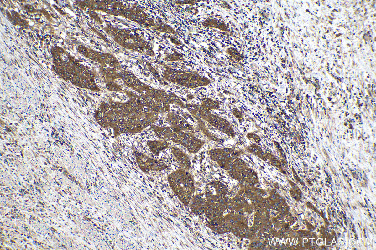 IHC staining of human oesophagus cancer using 67174-1-Ig (same clone as 67174-1-PBS)