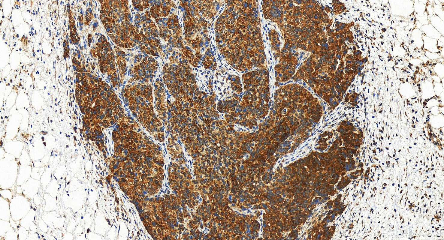 IHC staining of human ovary cancer using 19174-1-AP