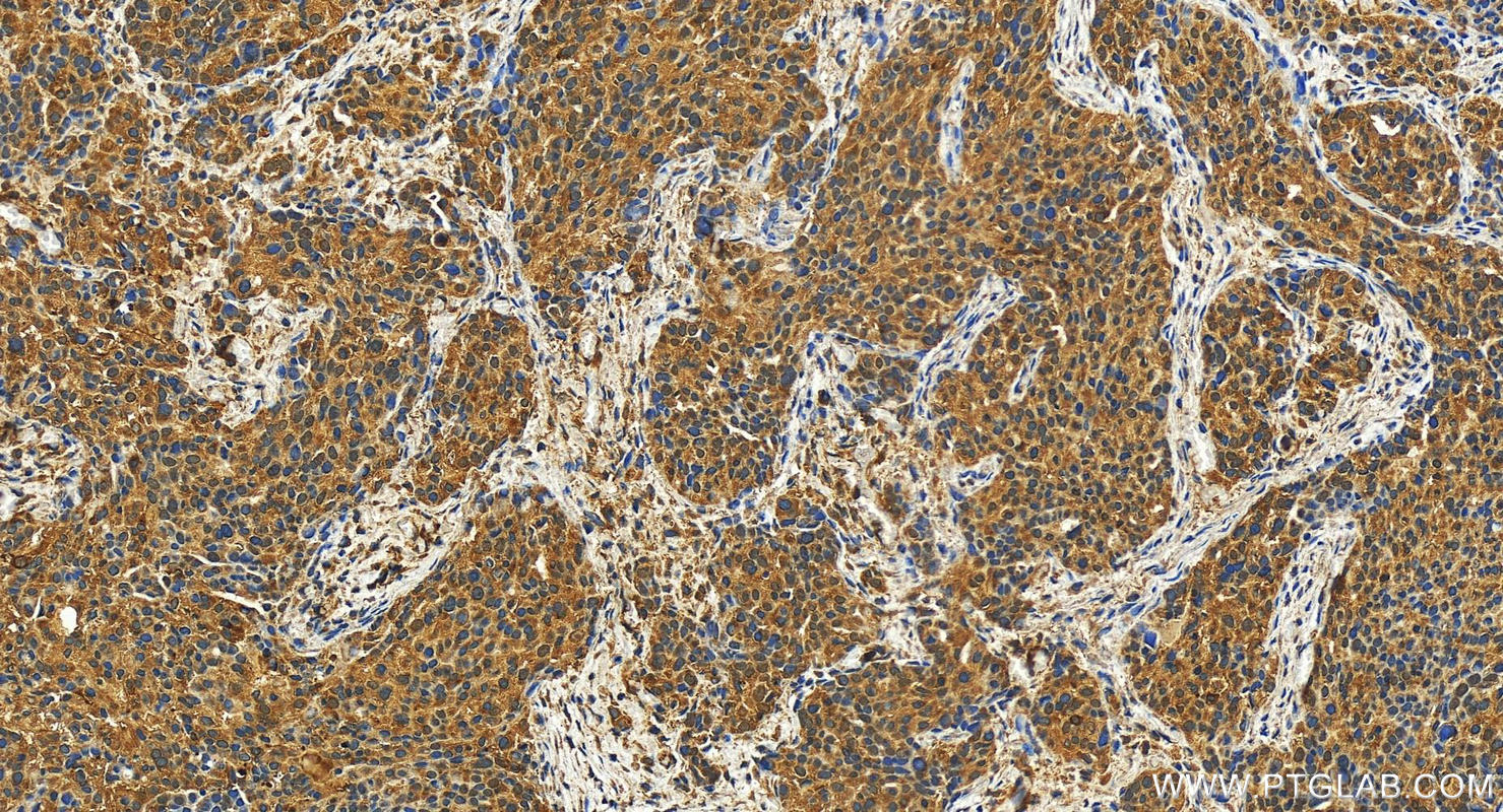 IHC staining of human ovary cancer using 27491-1-AP