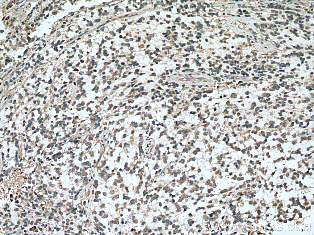 IHC staining of human gliomas using 17121-1-AP