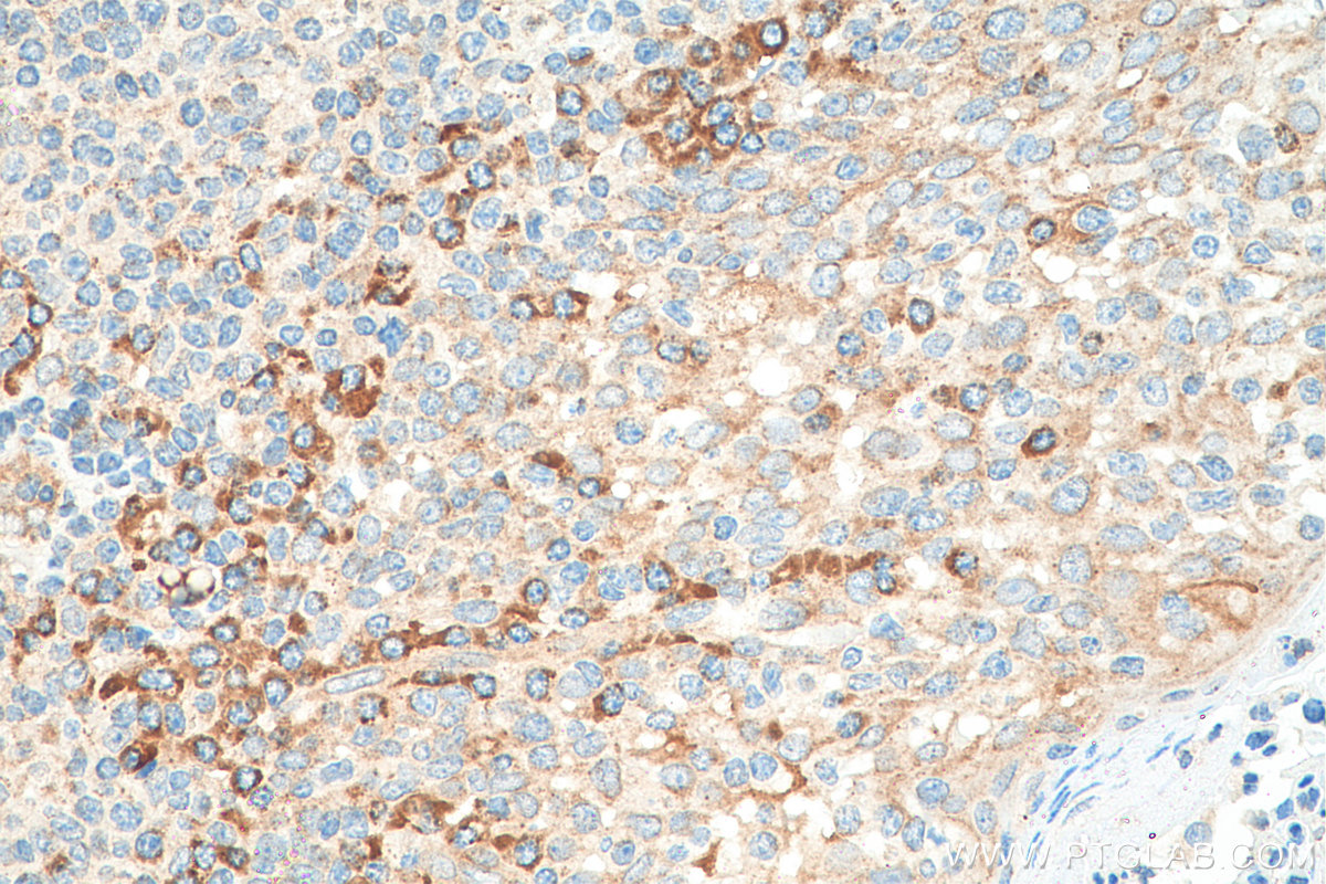 IHC staining of human tonsillitis using 26788-1-AP