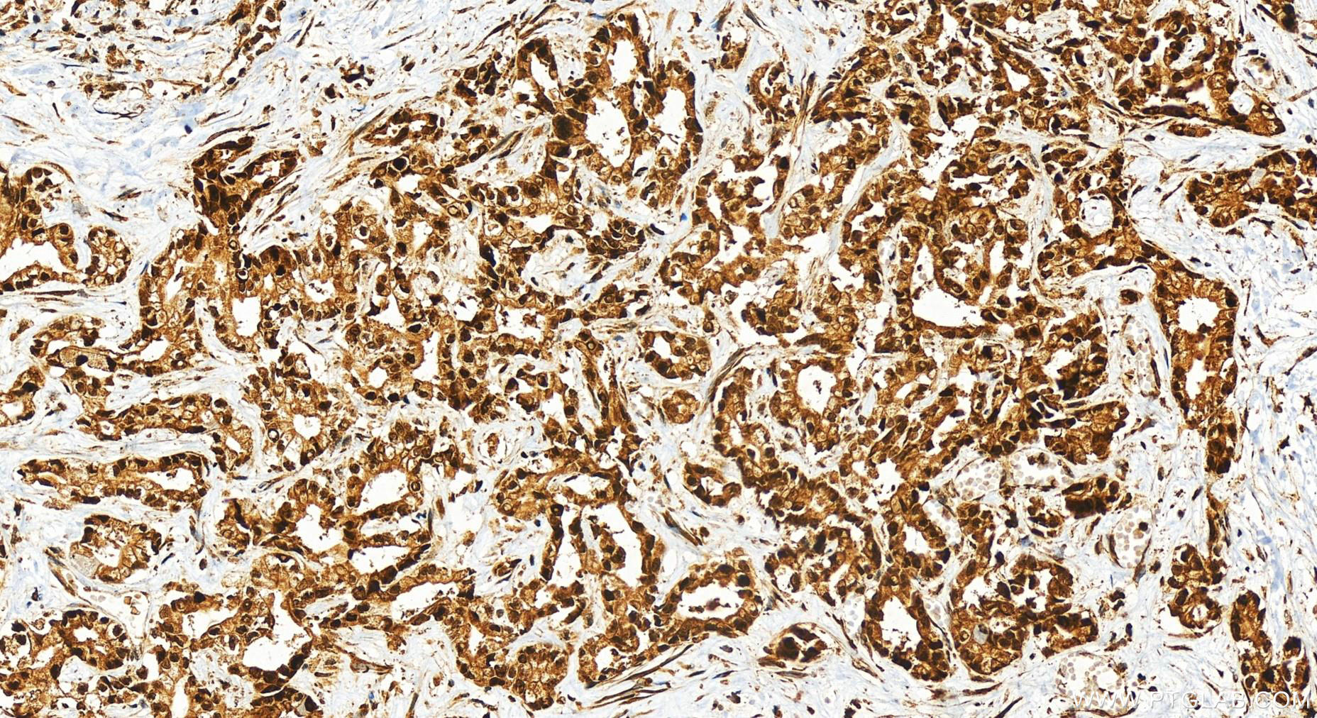 IHC staining of human intrahepatic cholangiocarcinoma using 10048-2-Ig