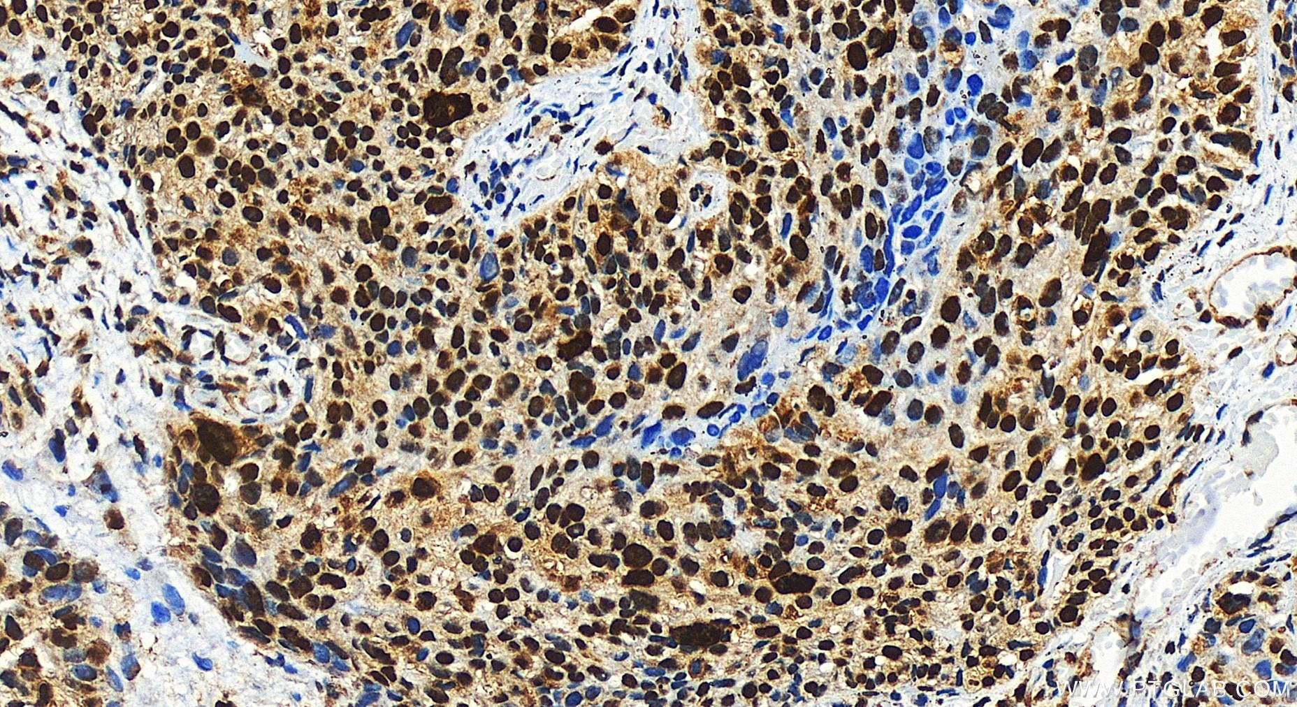 IHC staining of human ovary cancer using 30373-1-AP