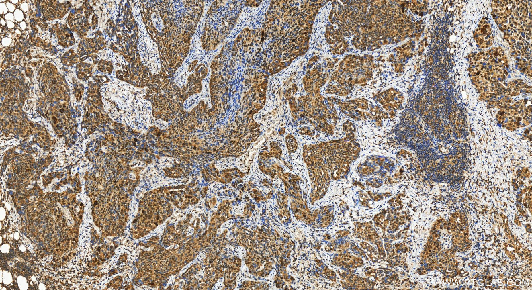 IHC staining of human ovary cancer using 30374-1-AP