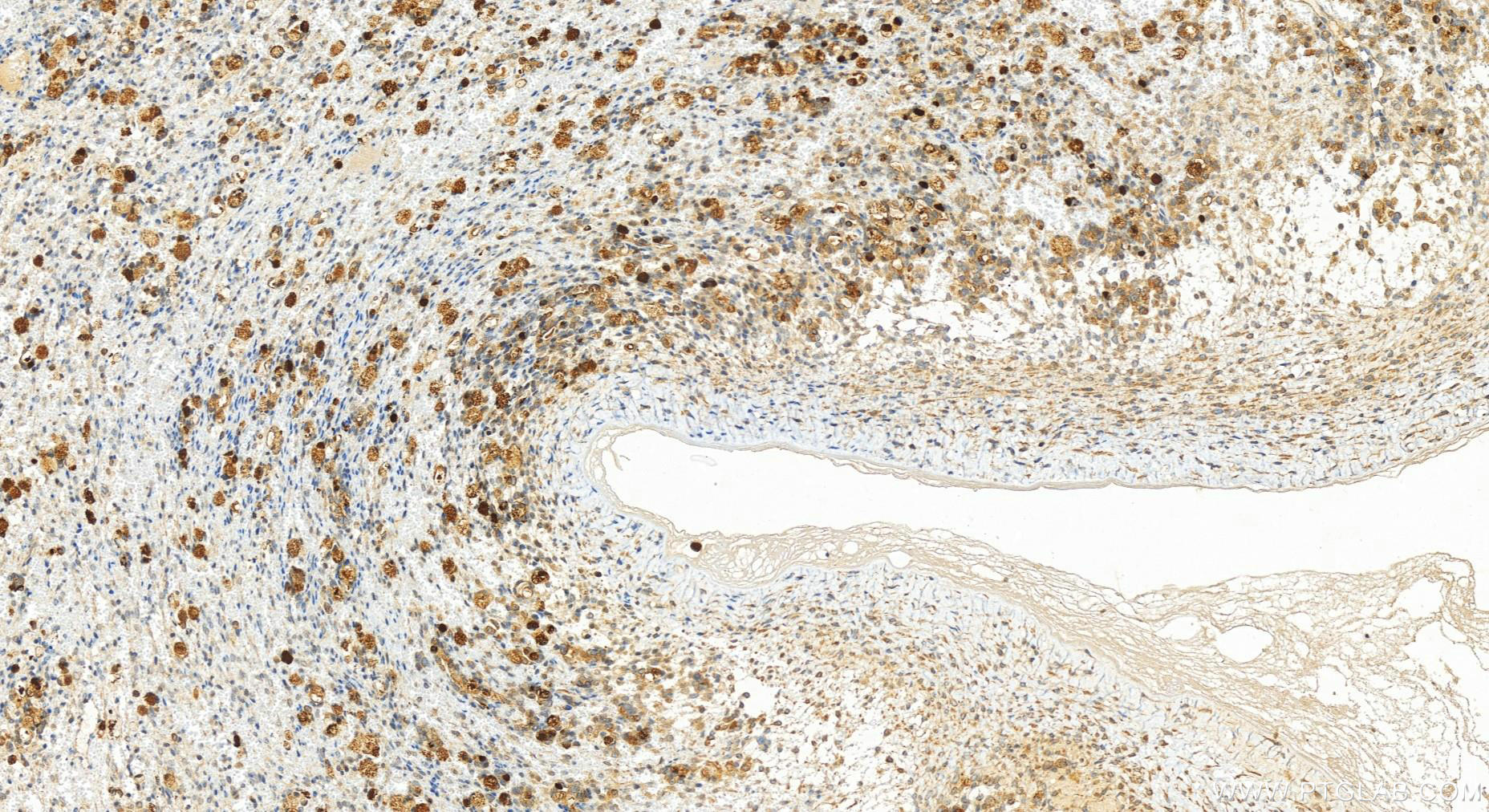 IHC staining of human ovary cancer using 21269-1-AP