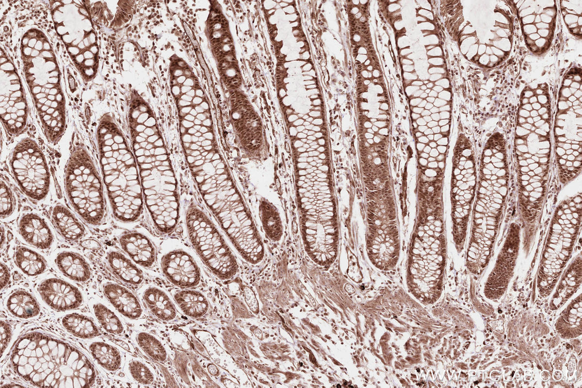 IHC staining of human rectal cancer using 11882-1-AP (same clone as 11882-1-PBS)