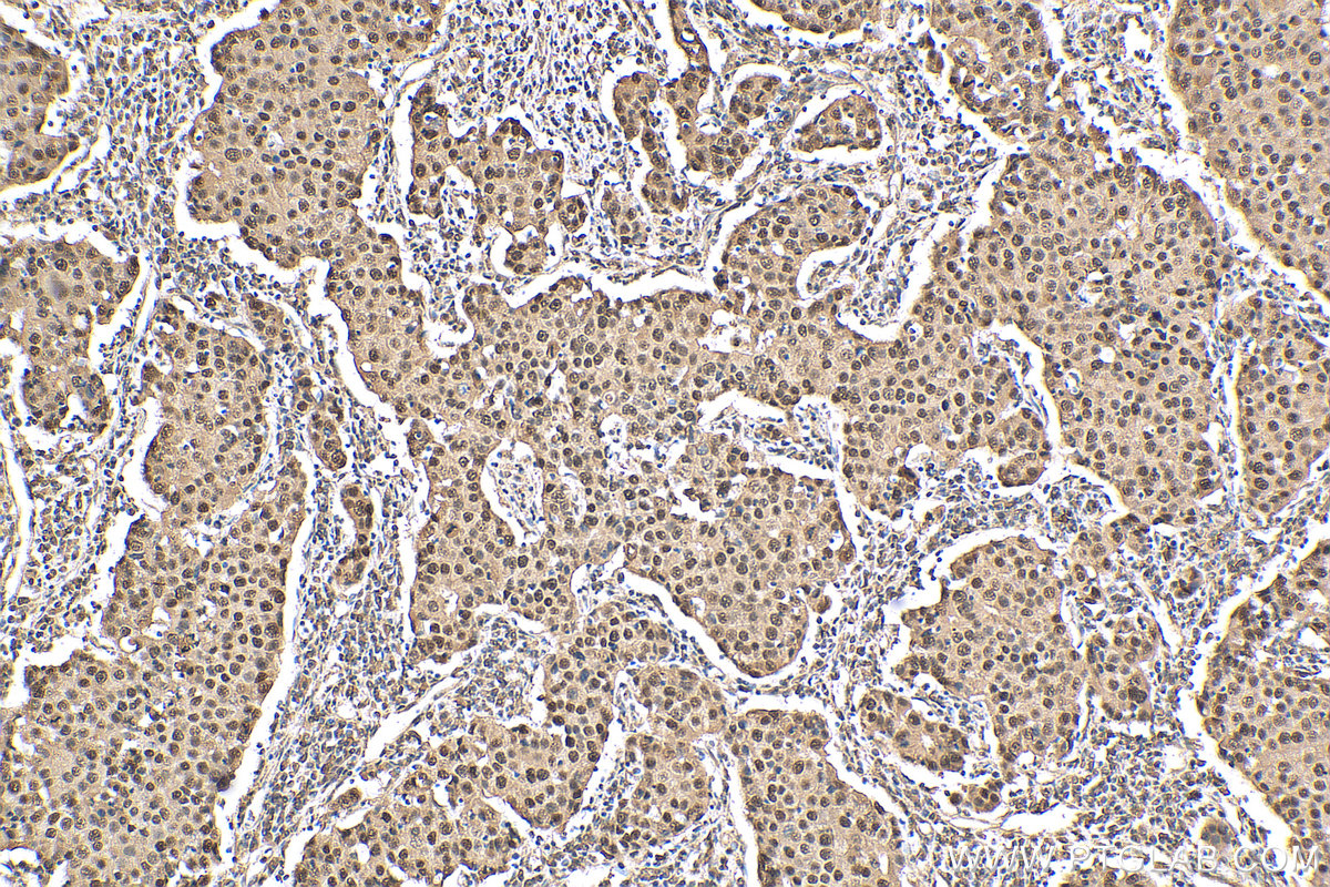 IHC staining of human breast cancer using 20365-1-AP