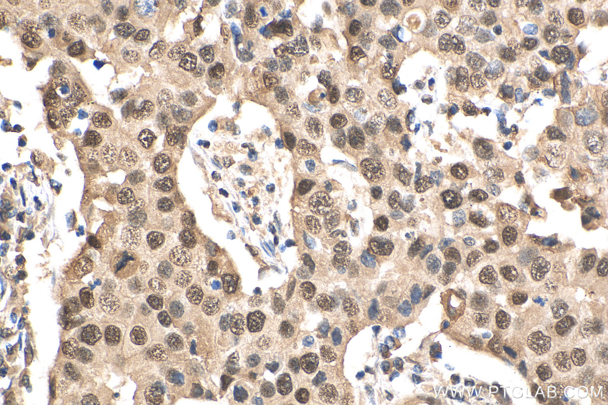 IHC staining of human breast cancer using 20365-1-AP