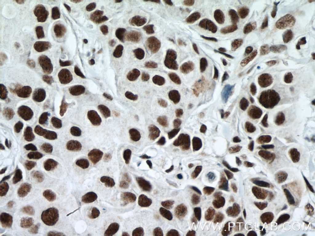 IHC staining of human breast cancer using 66059-1-Ig (same clone as 66059-1-PBS)