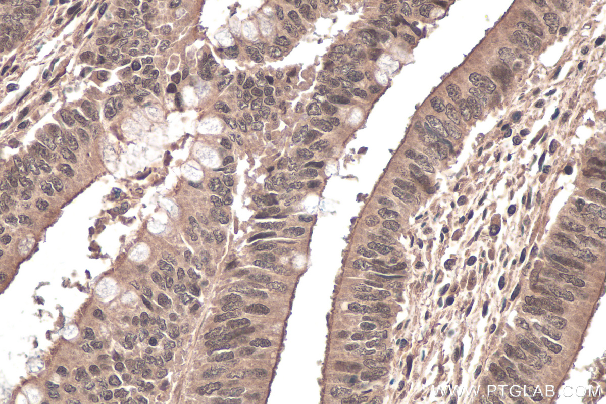 IHC staining of human colon cancer using 67506-1-Ig (same clone as 67506-1-PBS)