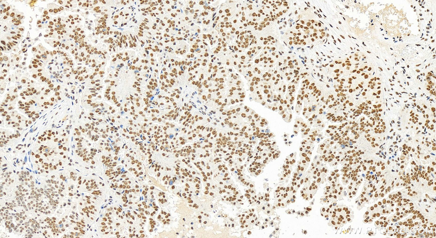 IHC staining of human ovary cancer using 13918-1-AP