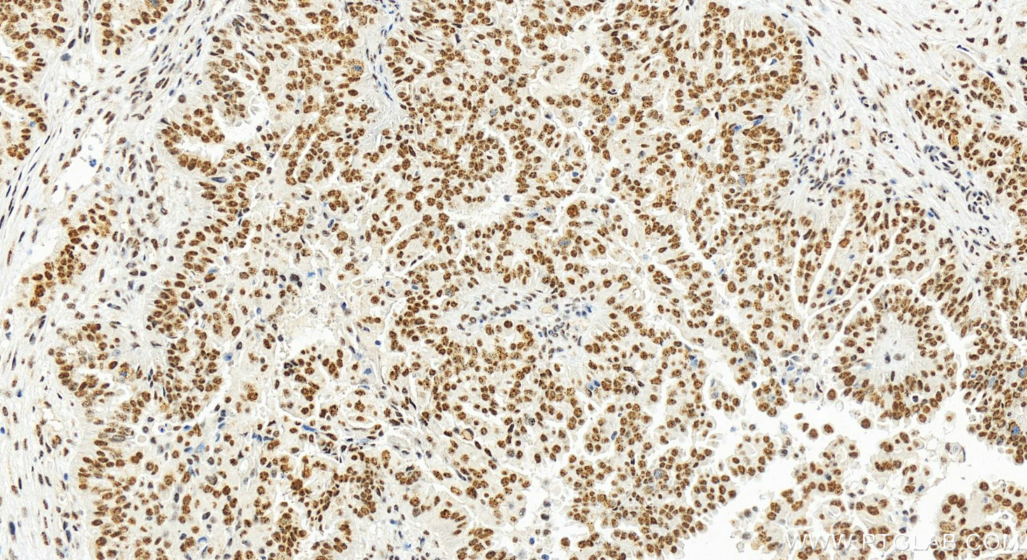 IHC staining of human ovary cancer using 15374-1-AP