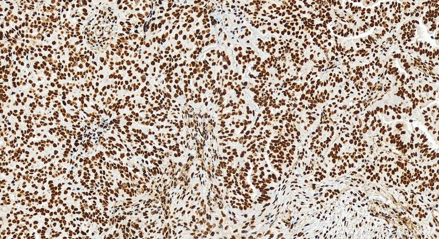 IHC staining of human ovarian  cancer using 82889-3-RR (same clone as 82889-3-PBS)