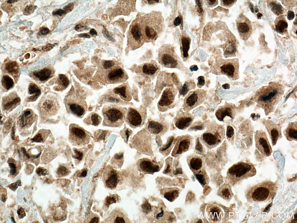 IHC staining of human breast cancer using 67420-1-Ig (same clone as 67420-1-PBS)