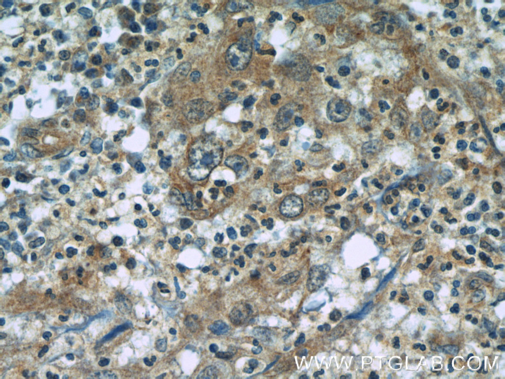 IHC staining of human cervical cancer using 60292-1-Ig (same clone as 60292-1-PBS)