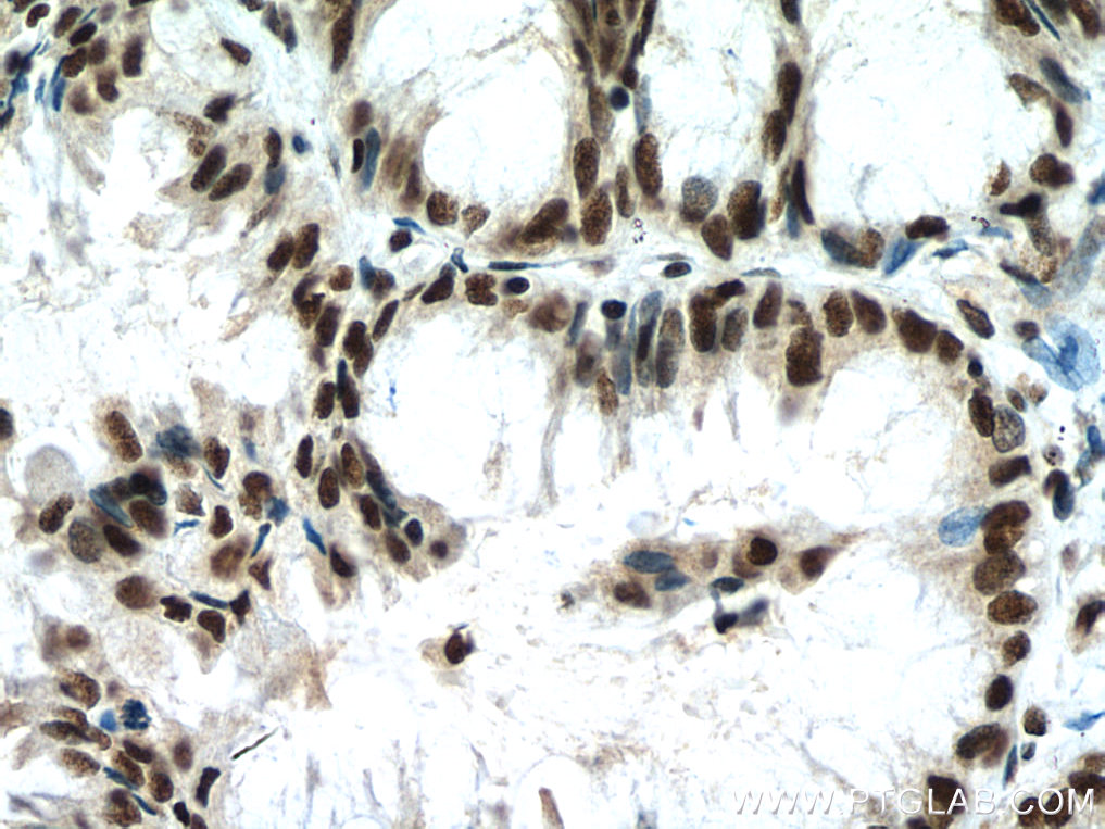 IHC staining of human lung cancer using 21896-1-AP