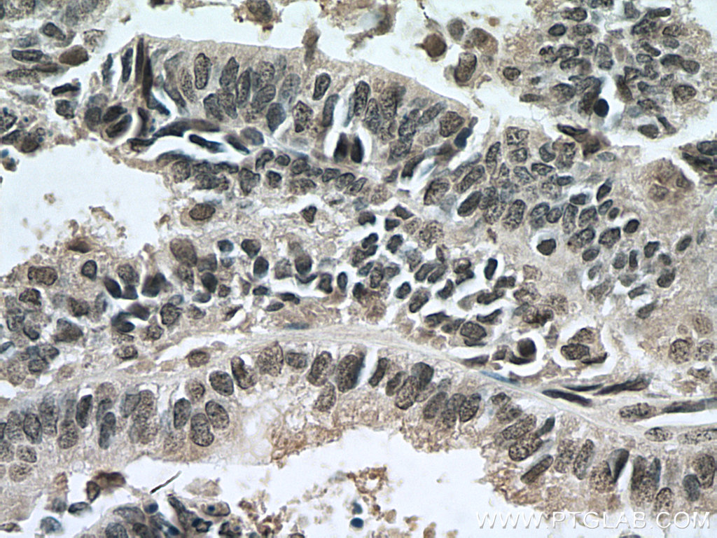 IHC staining of human ovary tumor using 67541-1-Ig (same clone as 67541-1-PBS)