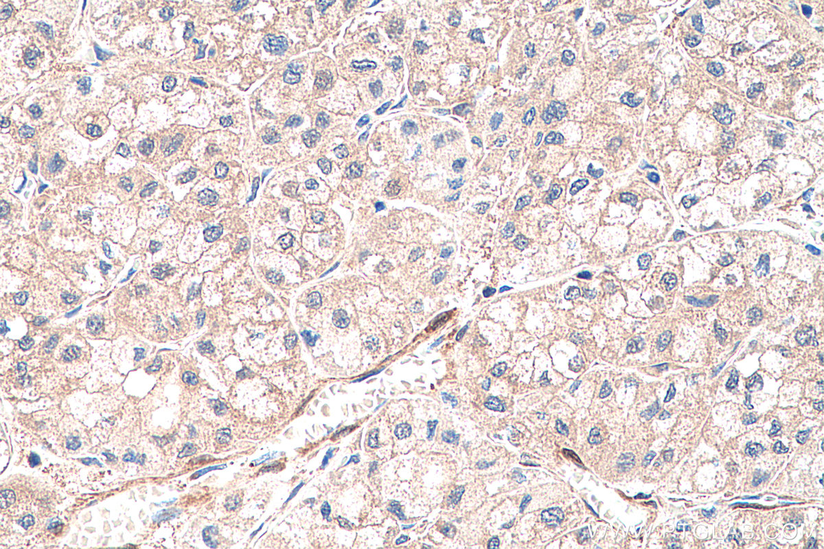 IHC staining of human liver cancer using 22683-1-AP