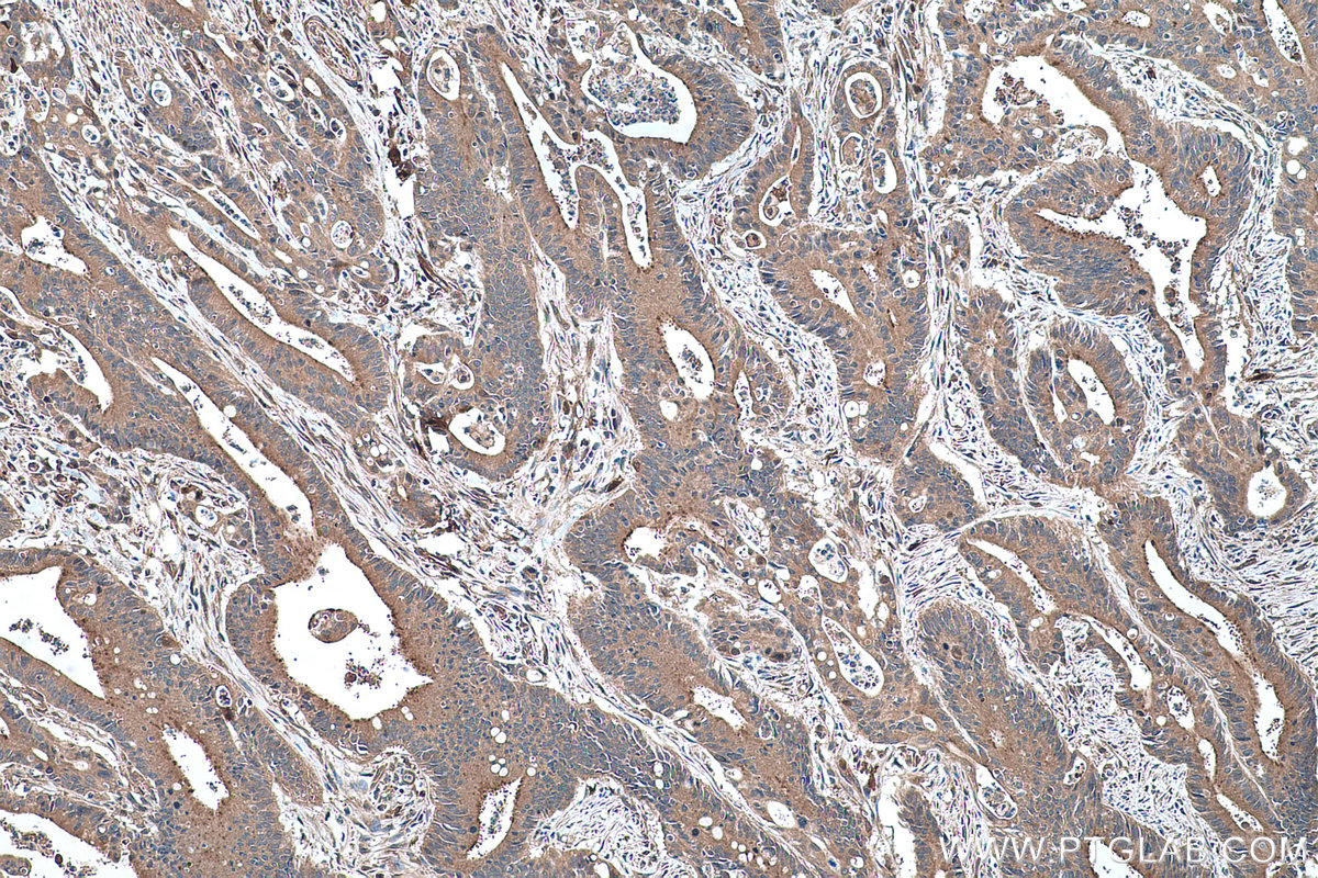 IHC staining of human colon cancer using 22683-1-AP