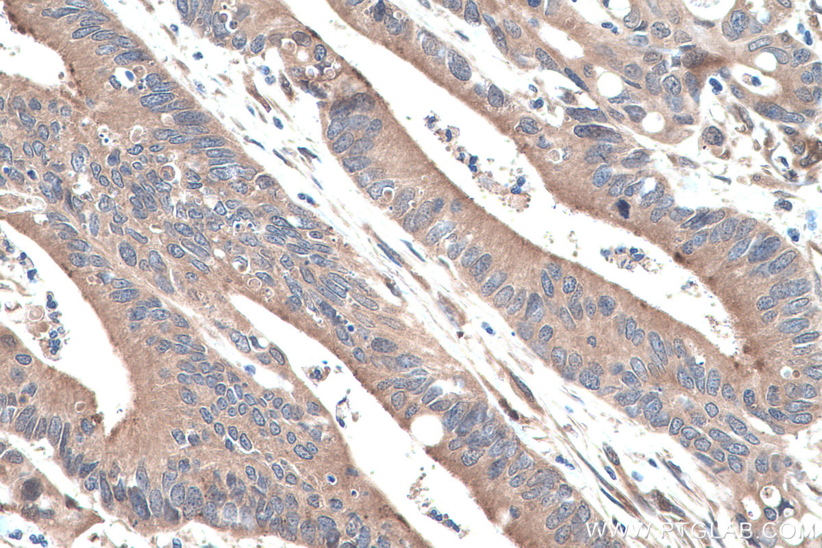 IHC staining of human colon cancer using 22683-1-AP