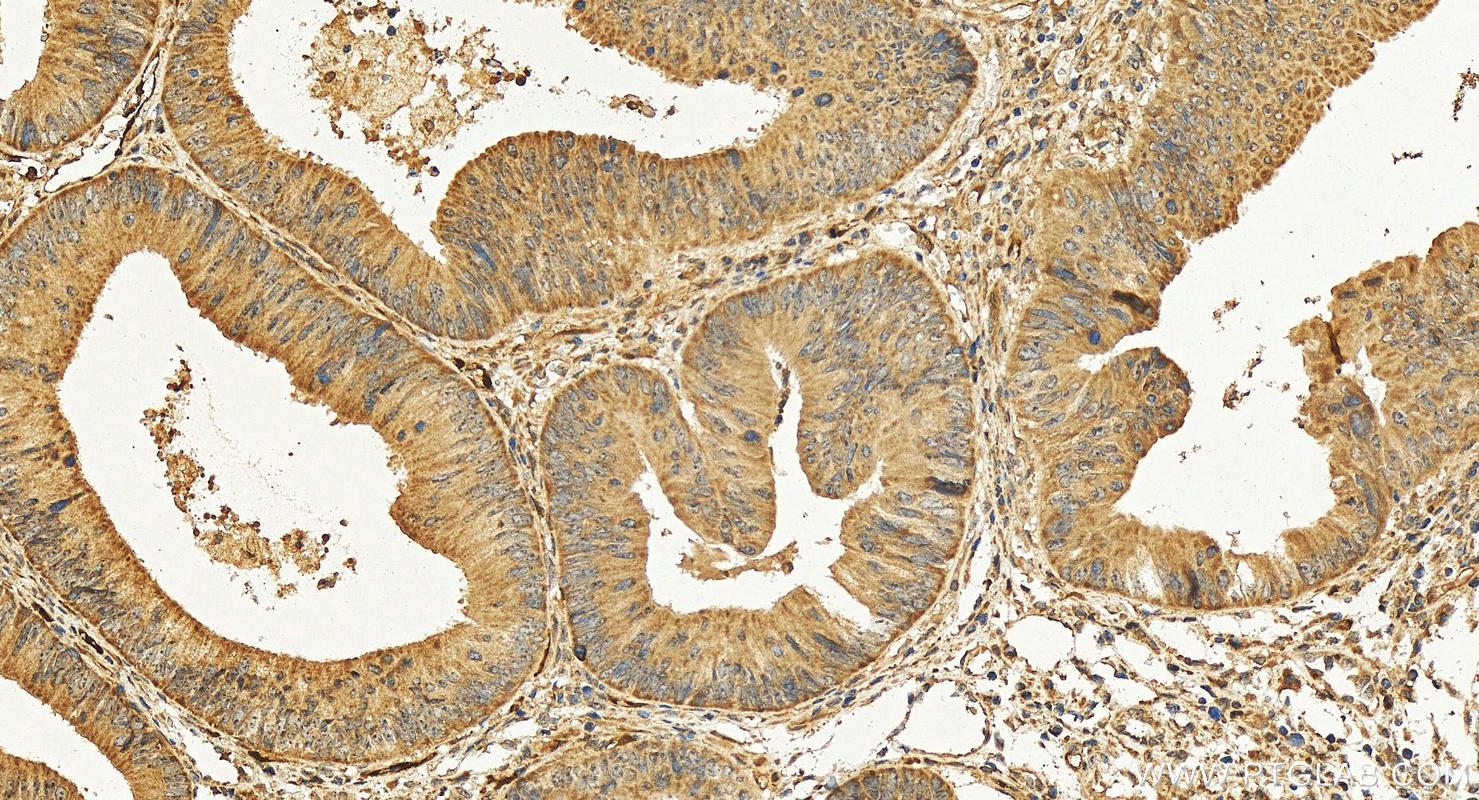 IHC staining of human colon cancer using 14541-1-AP