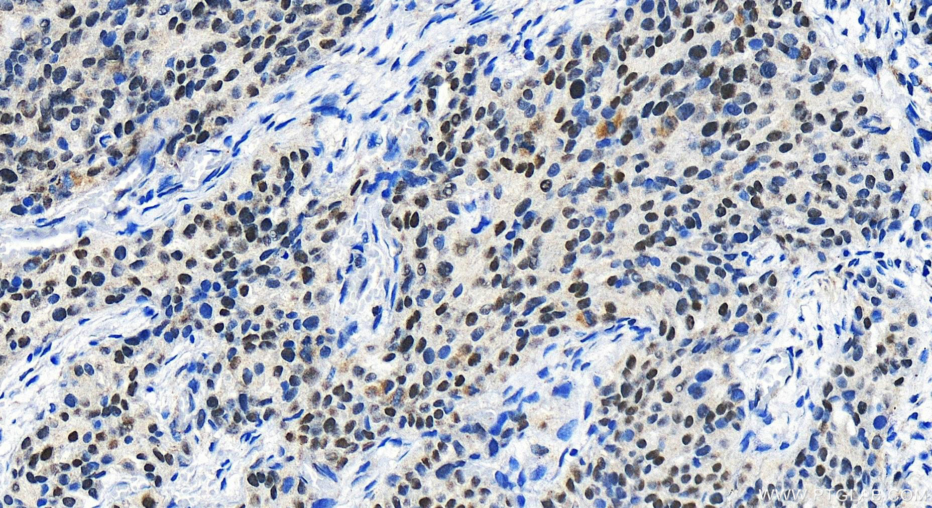 IHC staining of human ovary cancer using 27686-1-AP