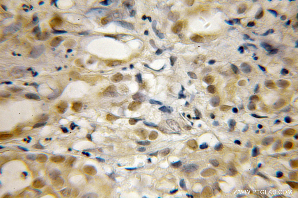 IHC staining of human pancreas cancer using 12468-2-AP