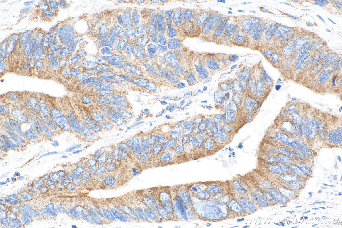 IHC staining of human colon cancer using 68119-1-Ig (same clone as 68119-1-PBS)