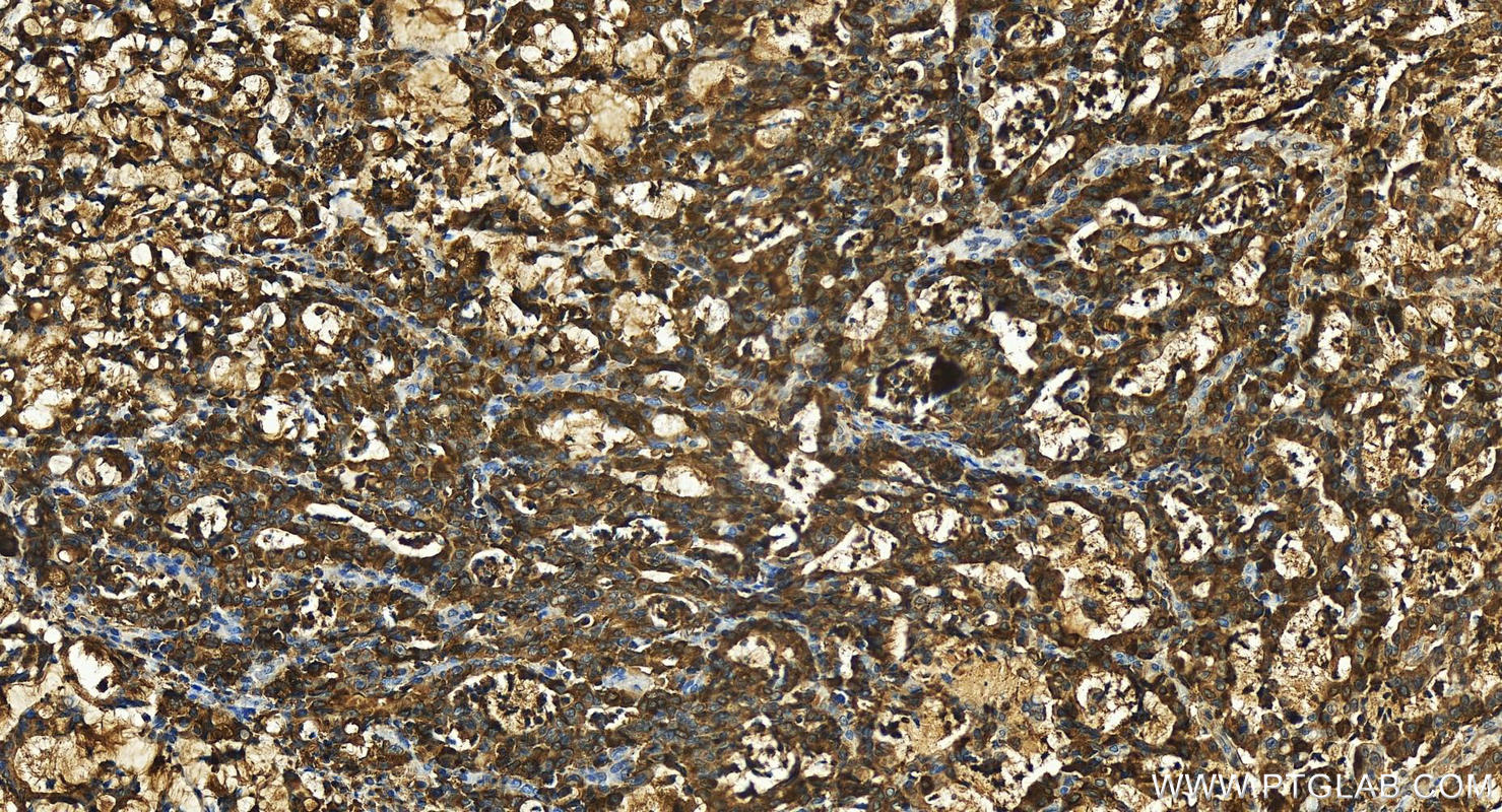 IHC staining of human stomach cancer using 15850-1-AP