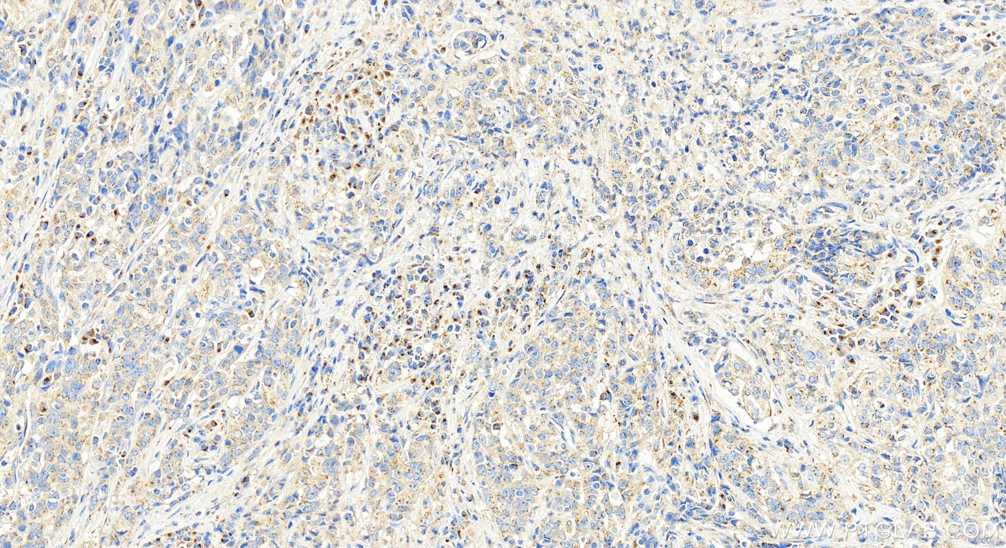 IHC staining of human stomach cancer using 15850-1-AP