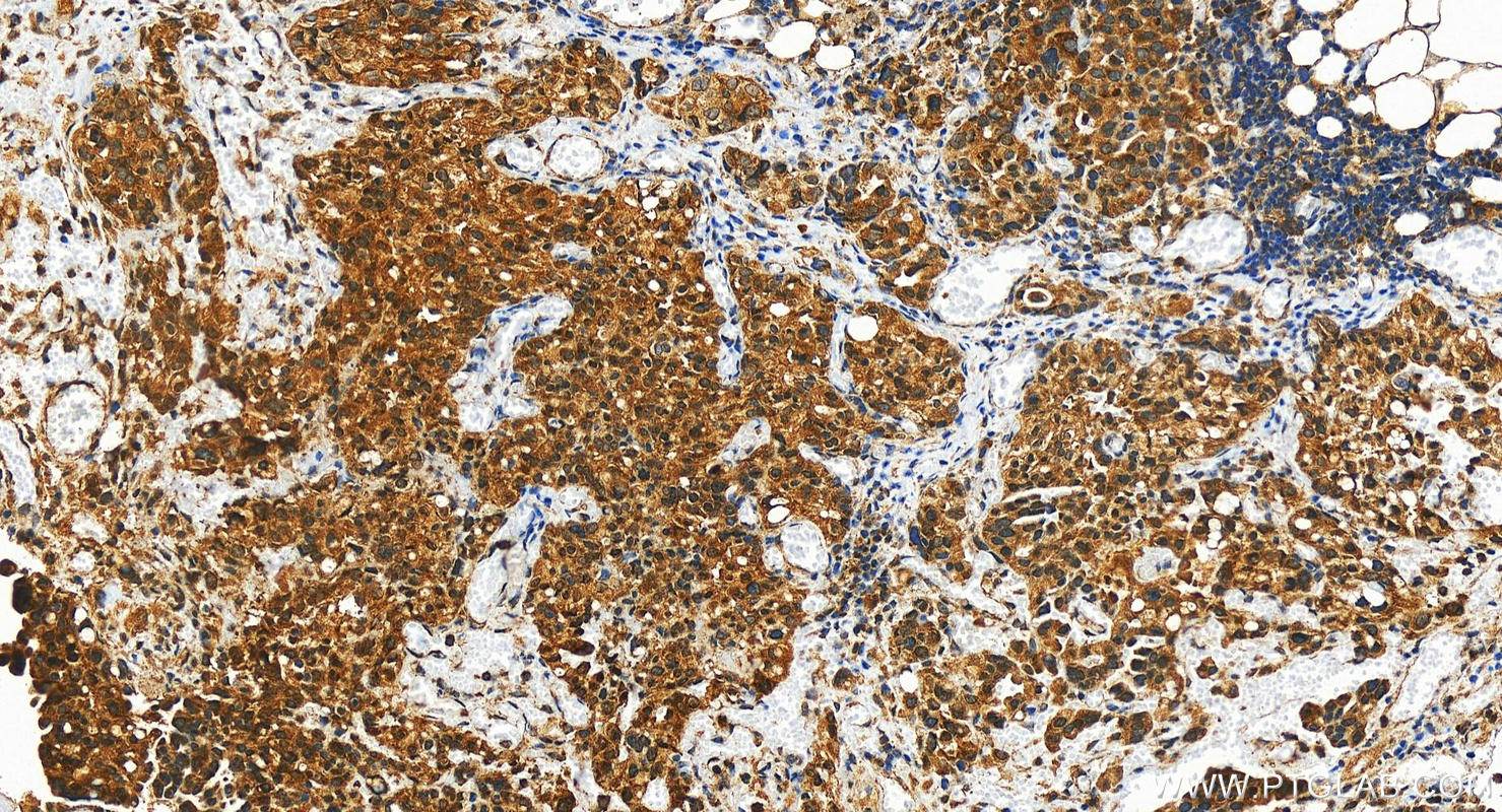 IHC staining of human ovary cancer using 29601-1-AP