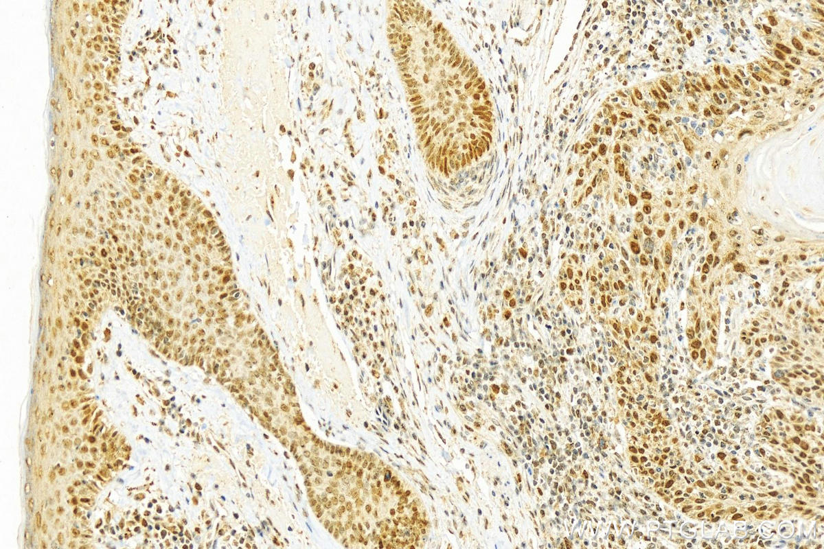 IHC staining of human skin cancer using 10806-1-AP