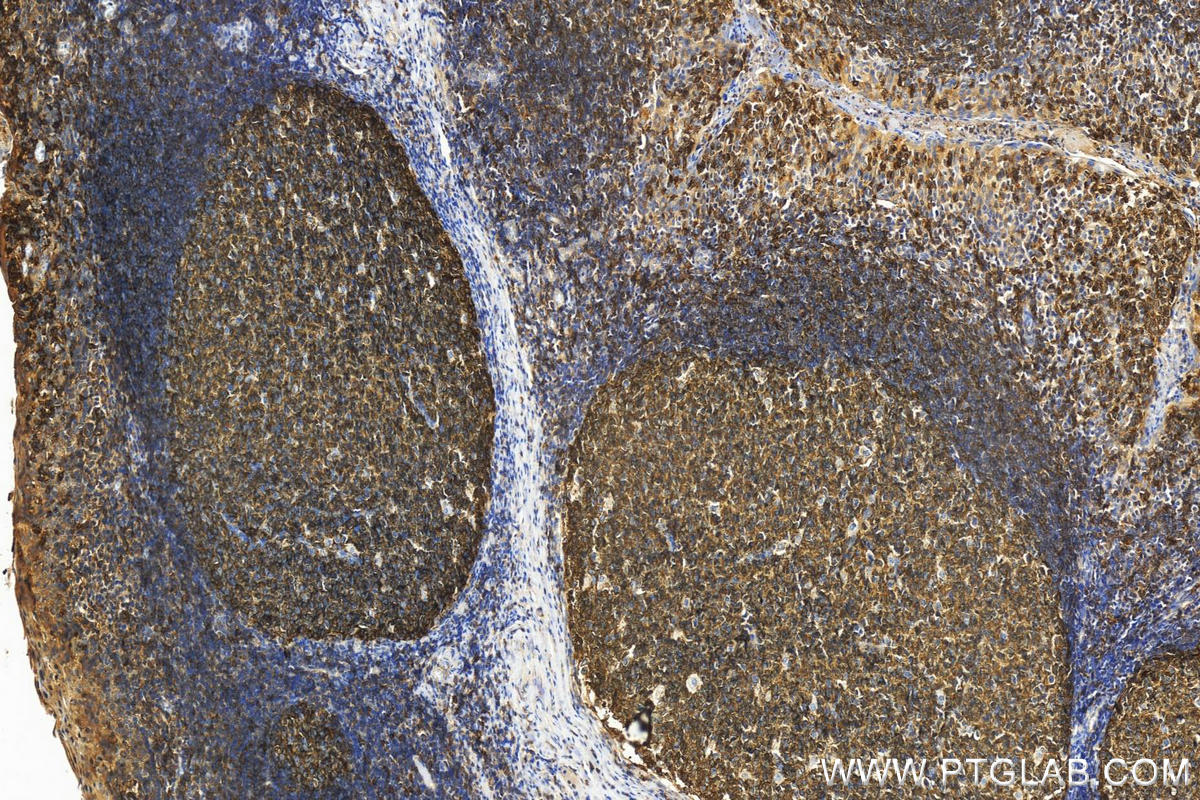 IHC staining of human tonsillitis using 24289-1-AP