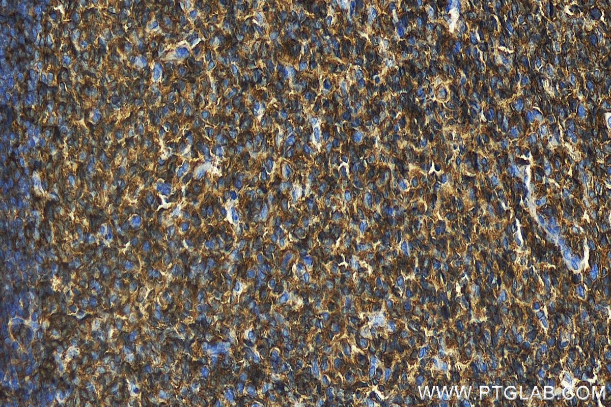 IHC staining of human tonsillitis using 24289-1-AP