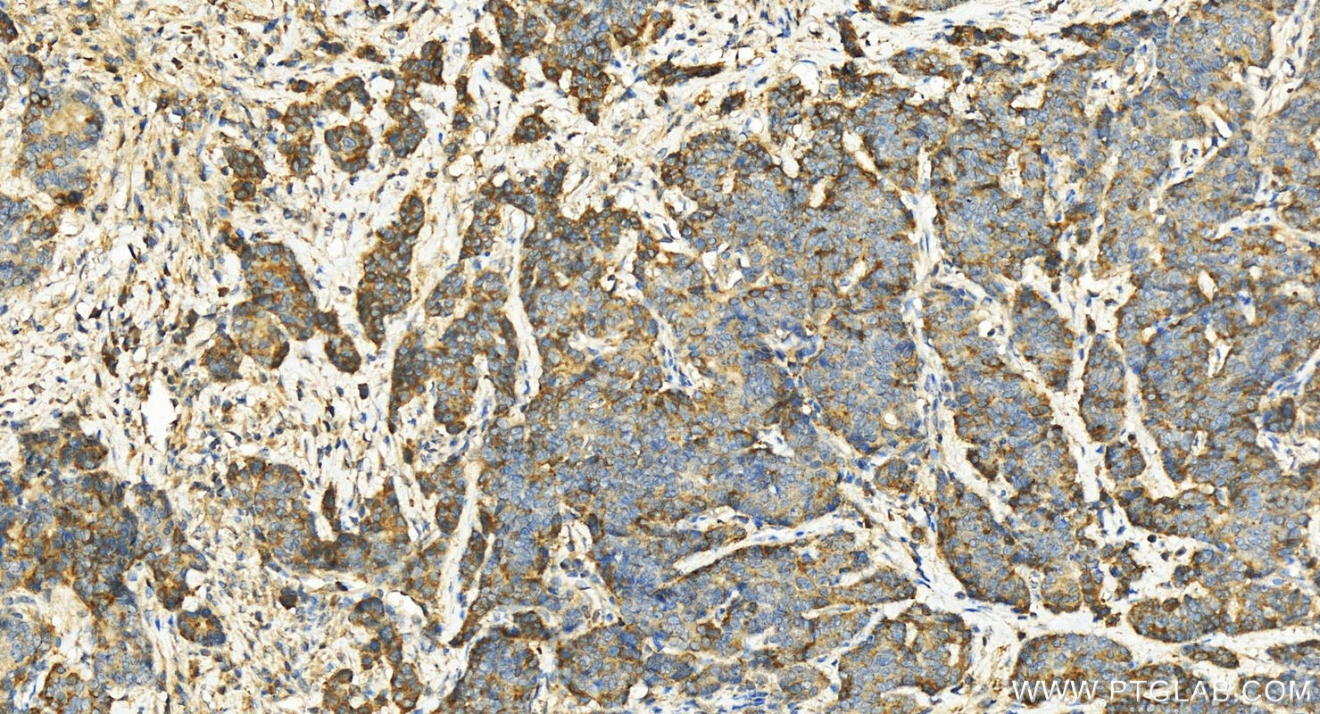 IHC staining of human stomach cancer using 12547-1-AP