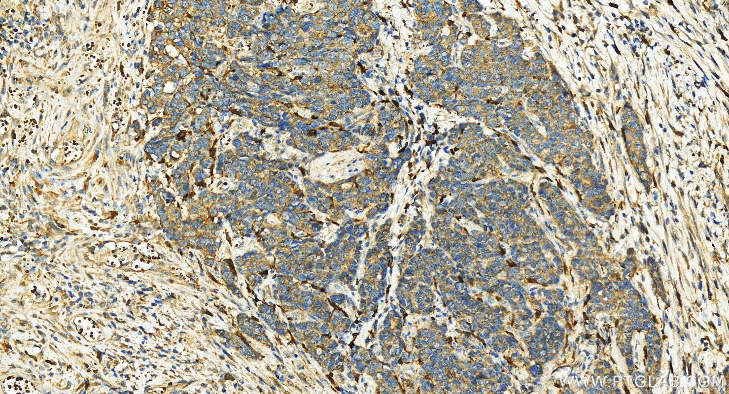 IHC staining of human stomach cancer using 10678-1-AP