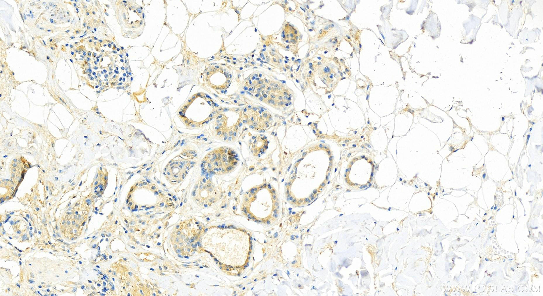 IHC staining of human skin cancer using 66714-1-Ig