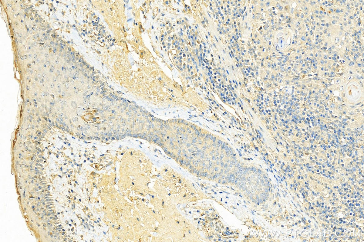 IHC staining of human skin cancer using 10632-1-AP